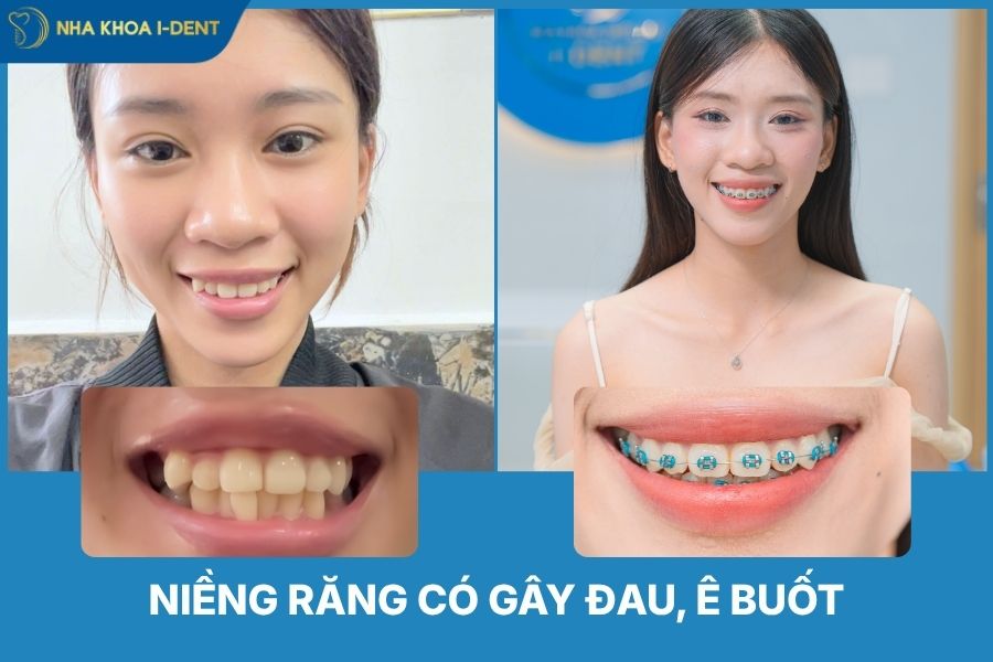 niềng răng có đau không
