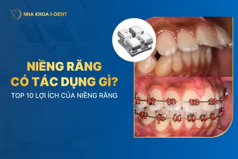 niềng răng có tác dụng gì