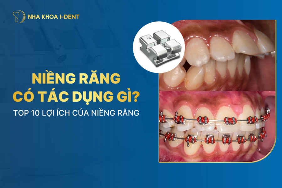 Niềng răng có tác dụng gì? 10 lợi ích của việc niềng răng