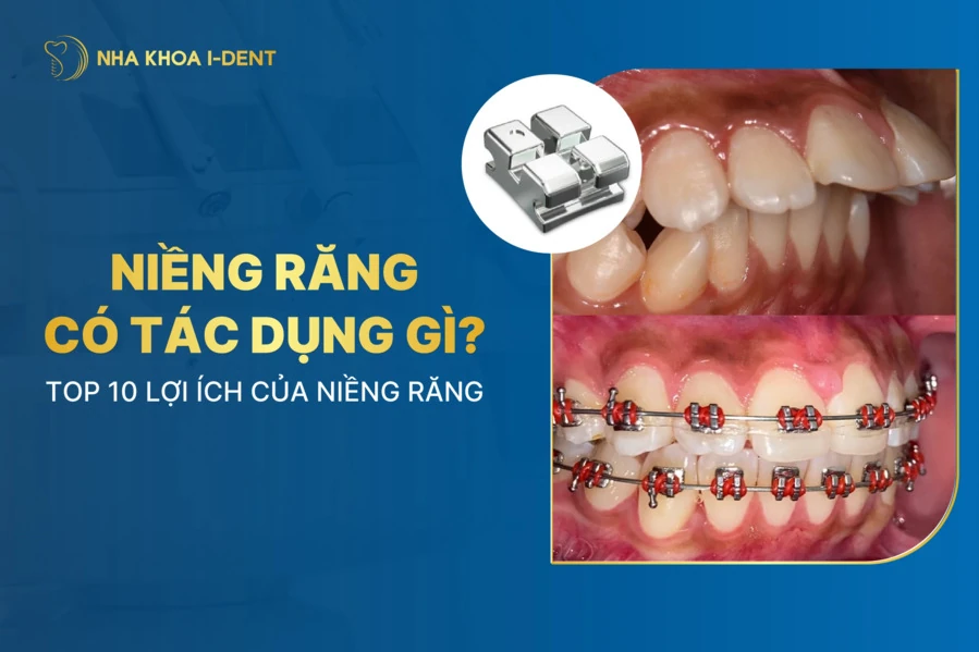 niềng răng có tác dụng gì