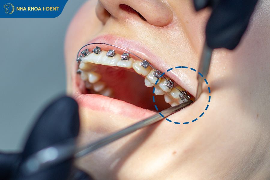 niềng răng đau nhất khi nào