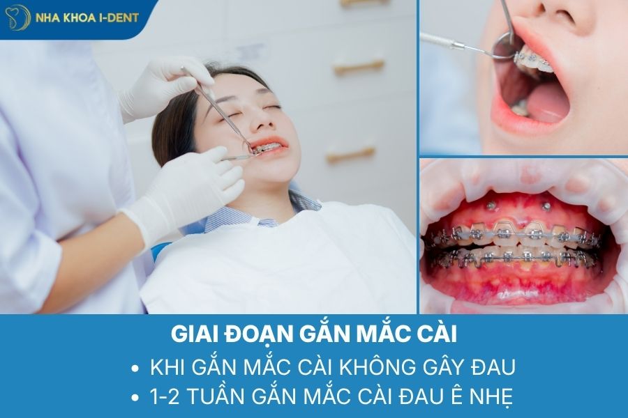 niềng răng đau nhẹ khi gắn mắc cài