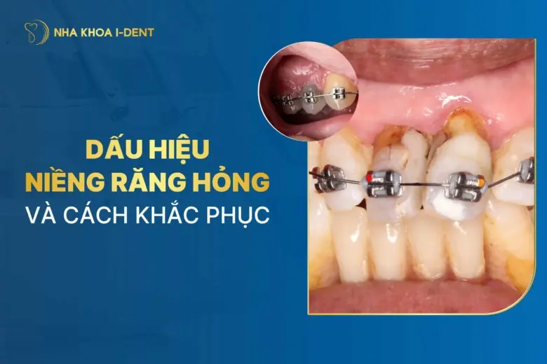 Dấu hiệu niềng răng hỏng và cách khắc phục