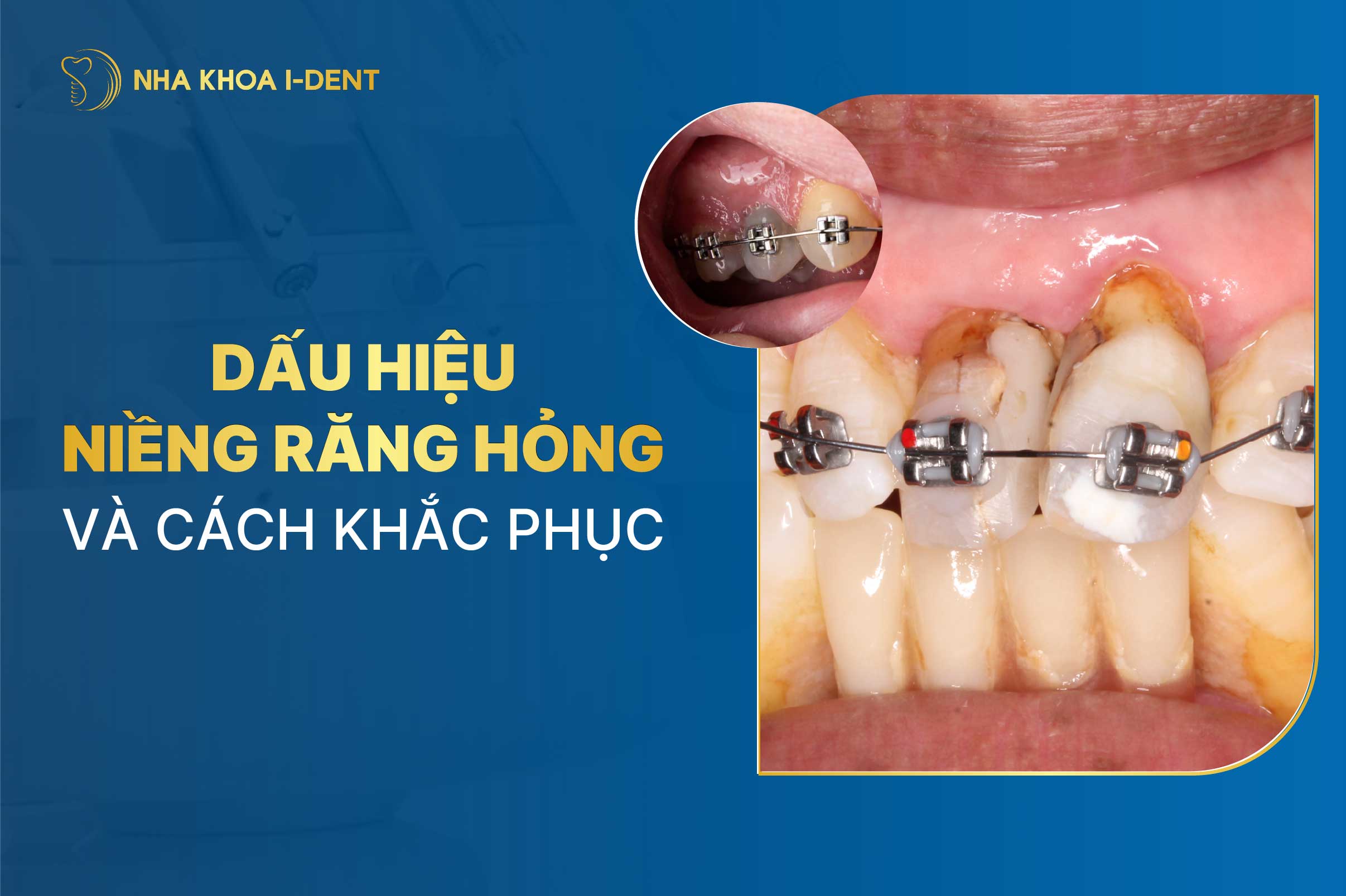 Niềng răng hỏng: Cách nhận biết và khắc phục