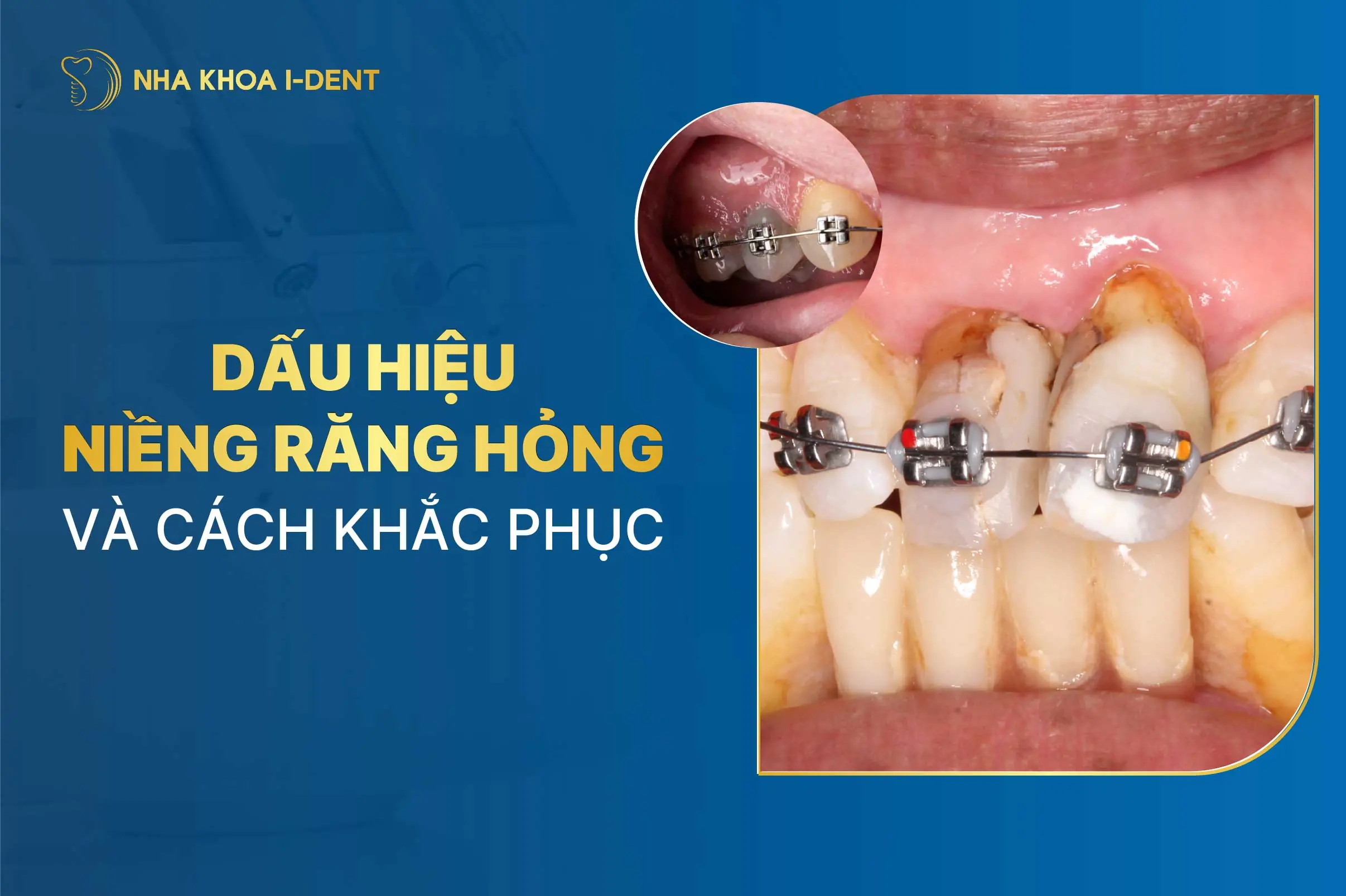 Dấu hiệu niềng răng hỏng và cách khắc phục