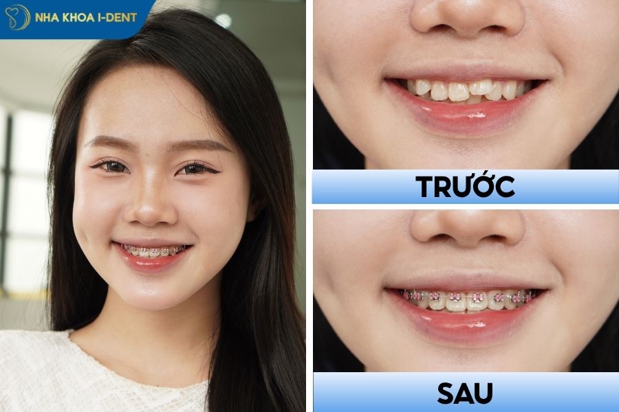 niềng răng không đau