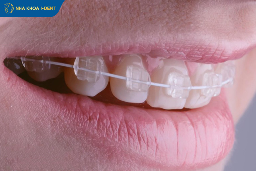 niềng răng sứ dây trong