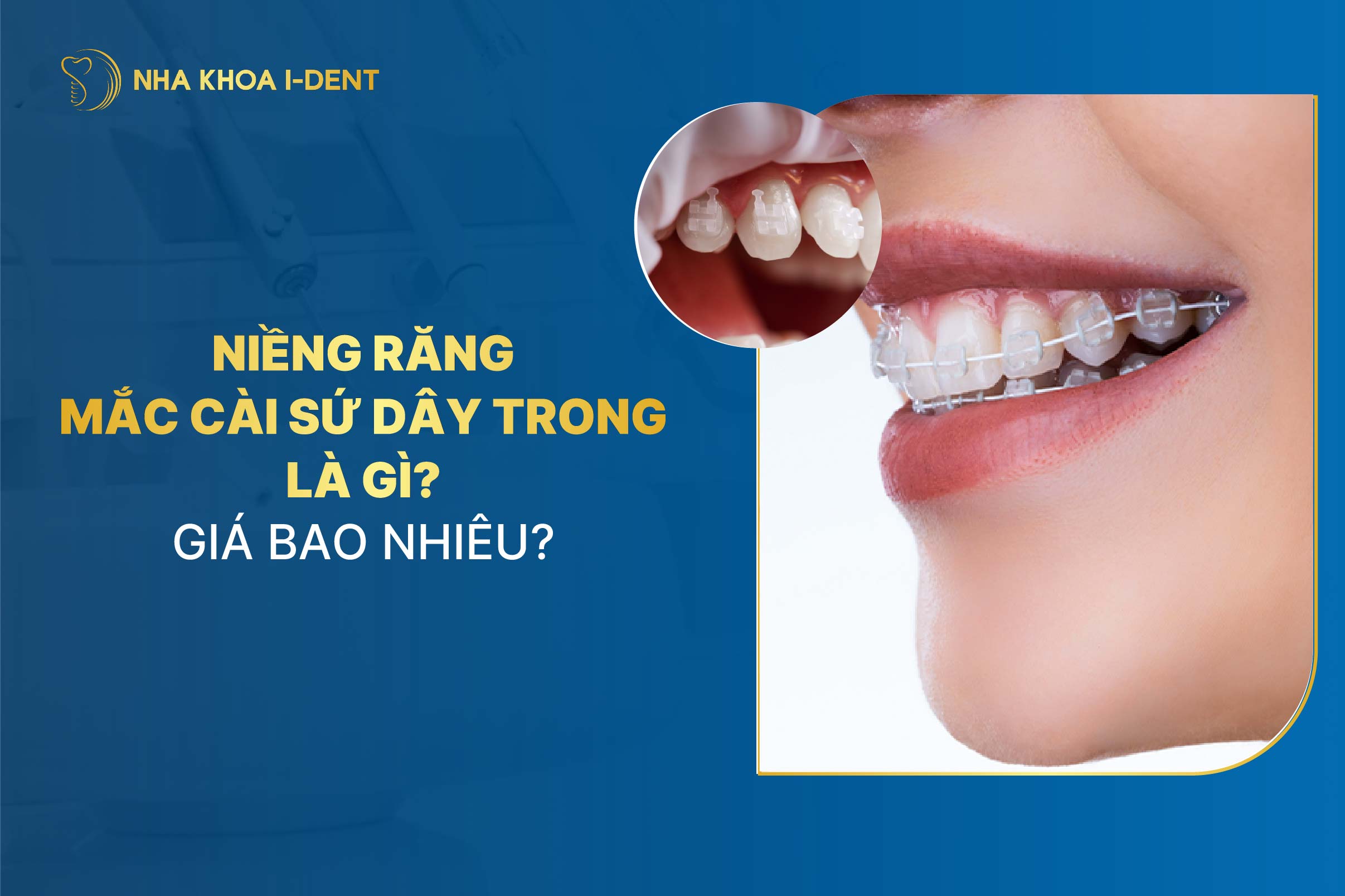 Niềng răng sứ dây trong là gì? Giá bao nhiêu?