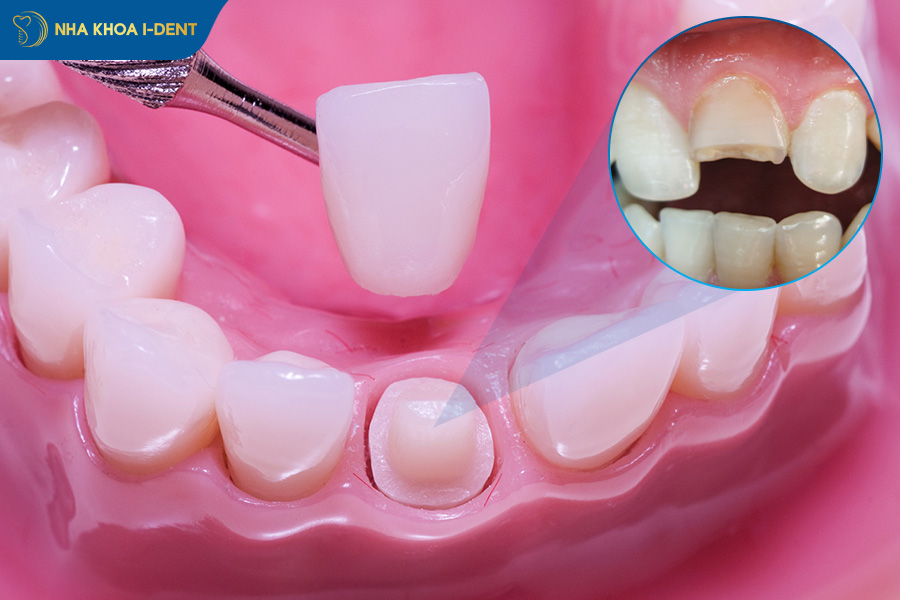 nứt gãy chân răng