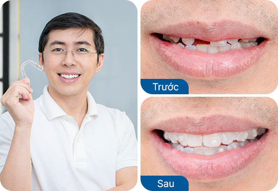 Anh Phan Văn Tuân niềng răng trong suốt Invisalign tại nha khoa I-Dent.