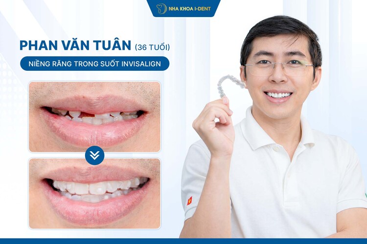 HÀNH TRÌNH NIỀNG RĂNG INVISALIGN CỦA KHÁCH HÀNG PHAN VĂN TUÂN: DUY TRÌ SỰ TỰ TIN TRONG LỊCH TRÌNH BẬN RỘN