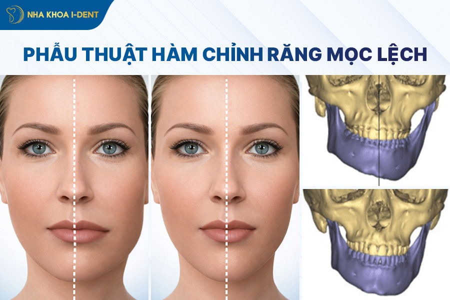 phẫu thuật hàm chỉnh răng mọc lệch không cần niềng