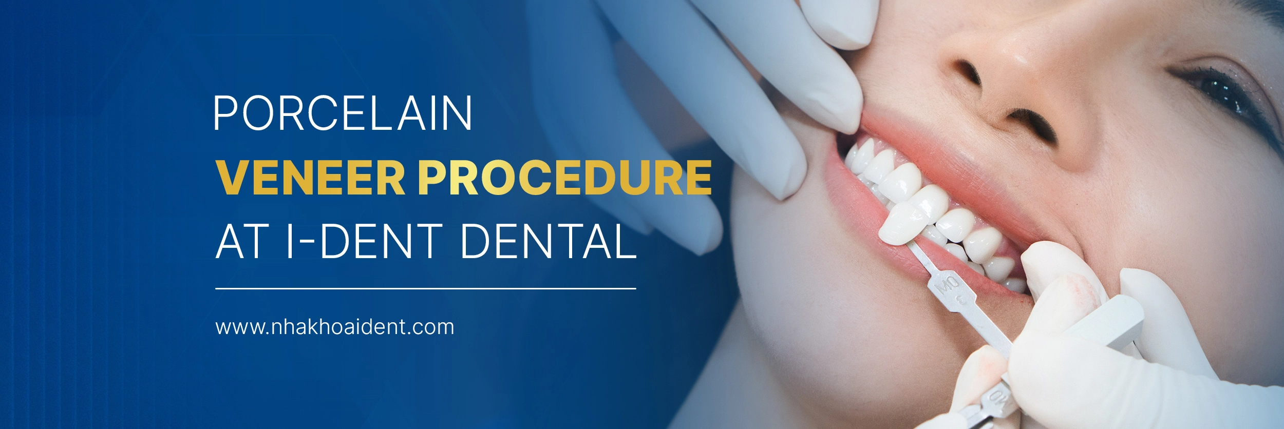 Porcelain Veneer Procedure