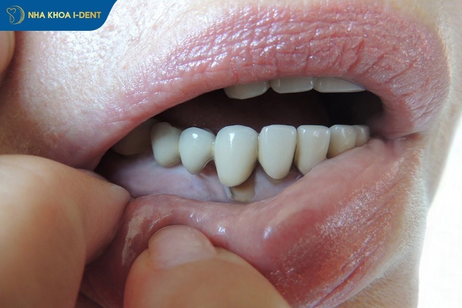 crown tooth price