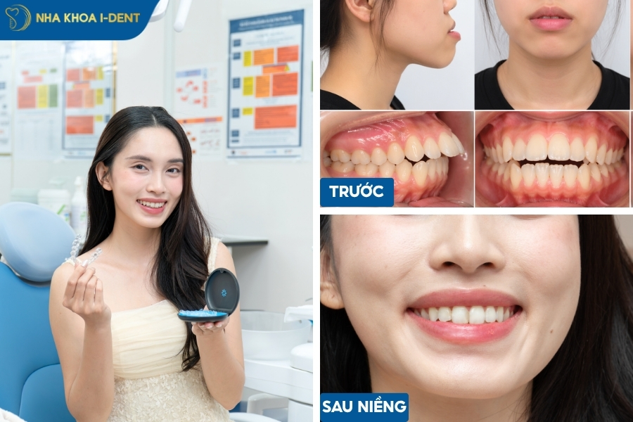 quy trình niềng răng invisalign