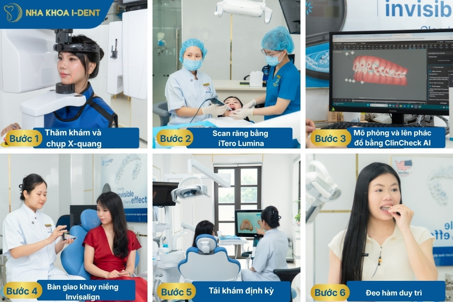 các bước niềng răng invisalign