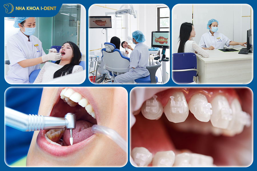 quy trình niềng răng sứ dây trong