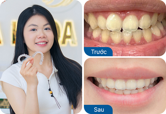 Chị Quỳnh đã niềng răng trong suốt Invisalign tại nha khoa I-Dent.