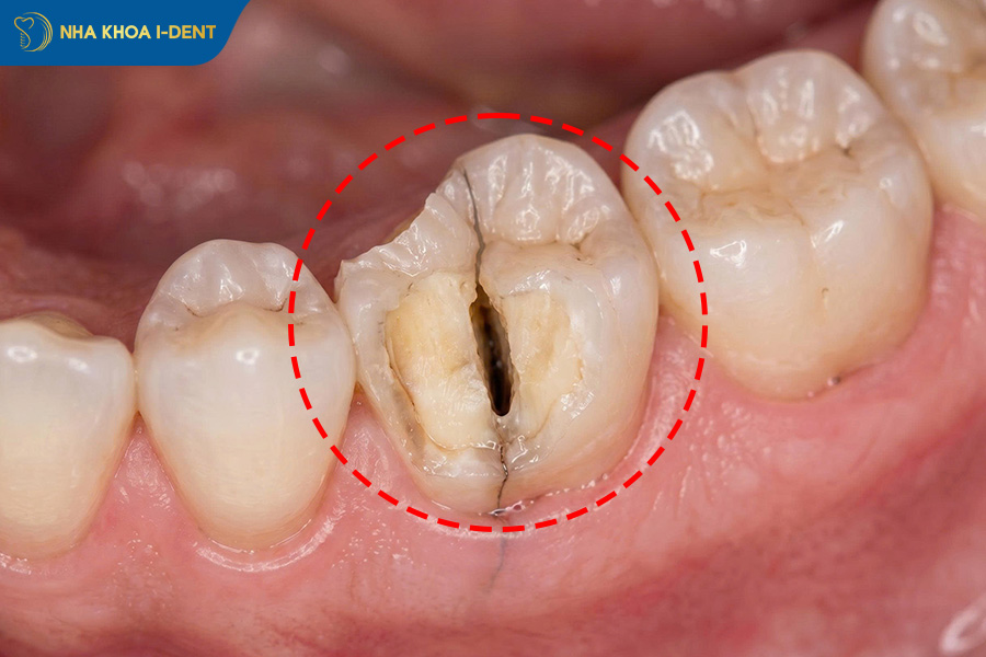 răng bị gãy chân