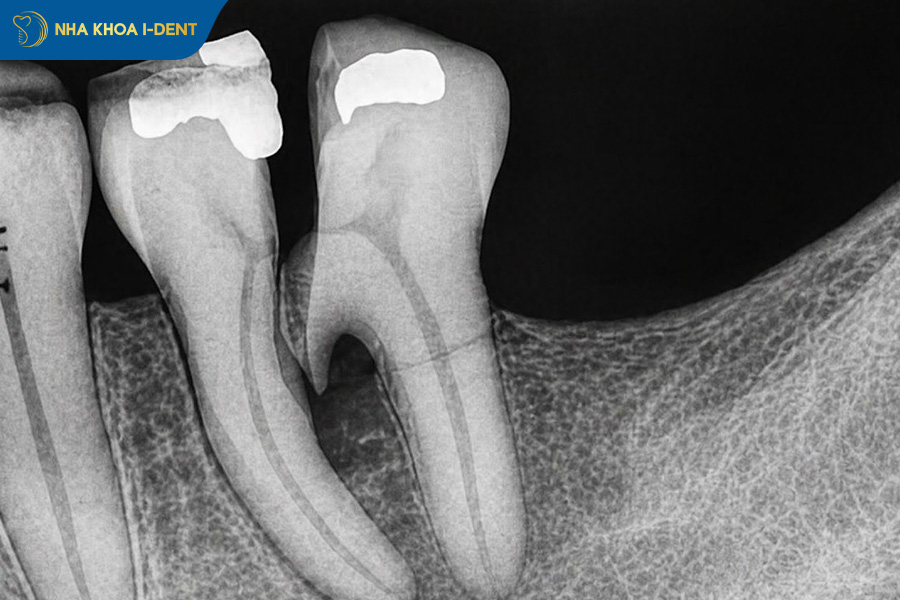 răng bị gãy đôi