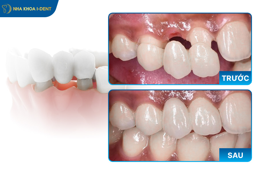 răng cấm có trồng được hay không