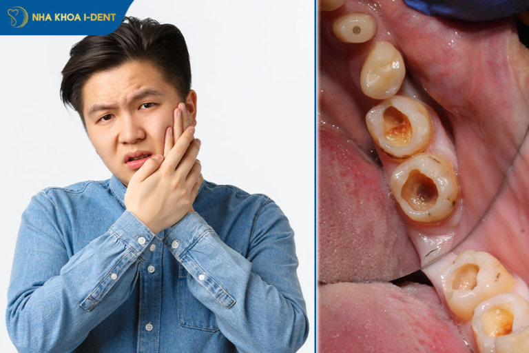 Răng đang đau có nhổ được không? Khi nào nên và không nên?