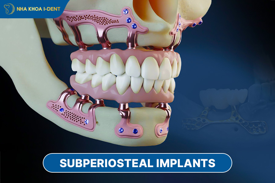 teeth implants