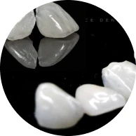 veneer teeth