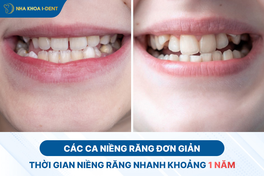 Mức độ phức tạp của răng tác động đến thời gian niềng răng