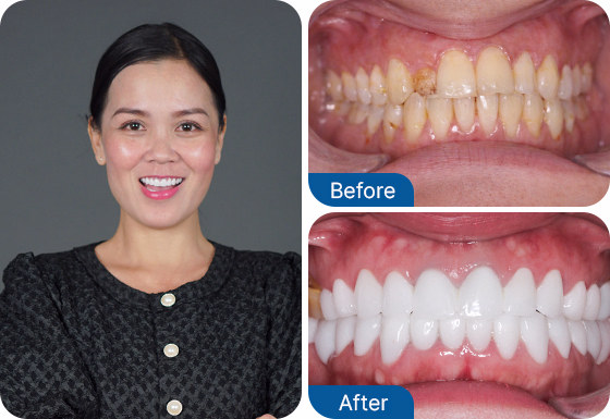 tooth veneers