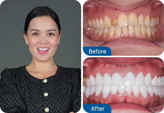 tooth veneers