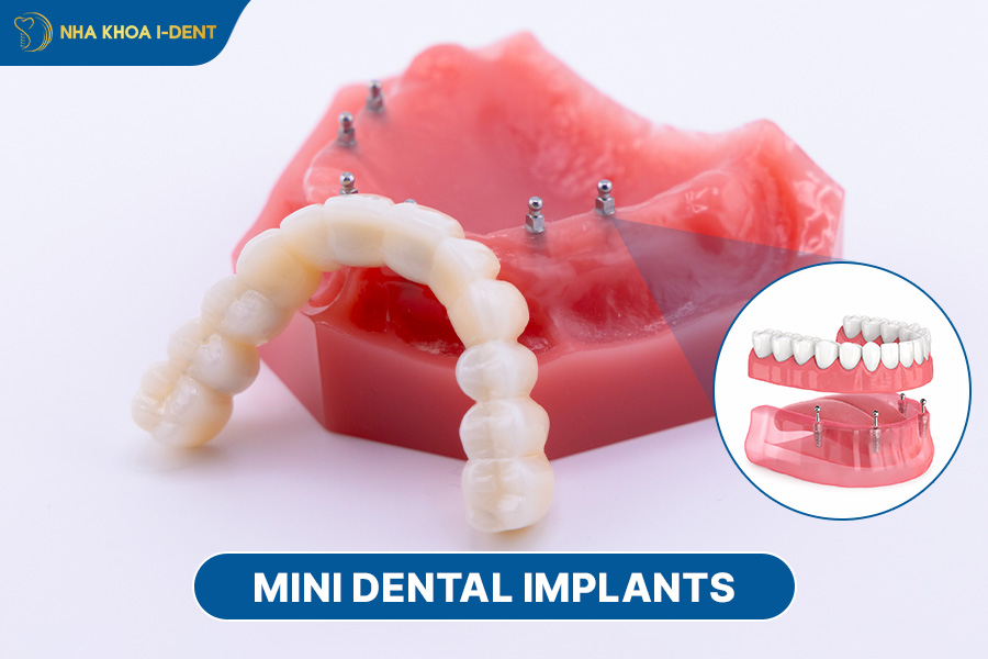 tooth implant