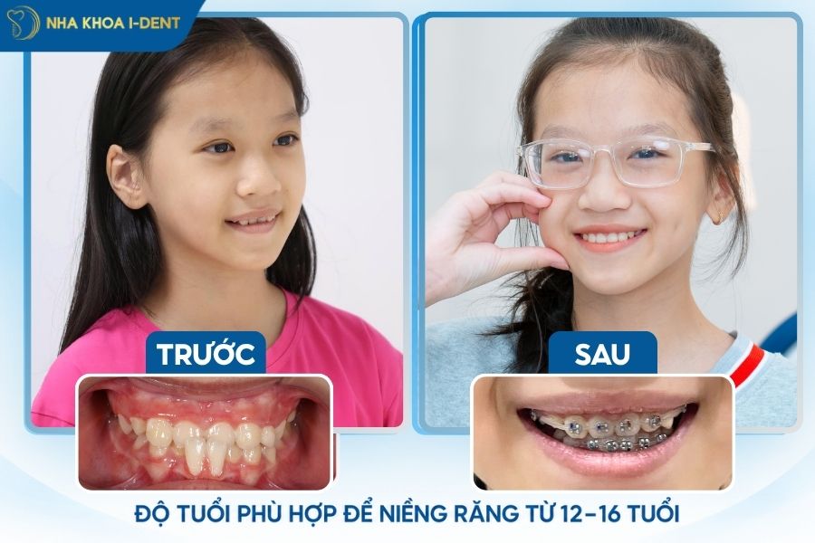 trẻ bao nhiêu tuổi thì niềng răng được