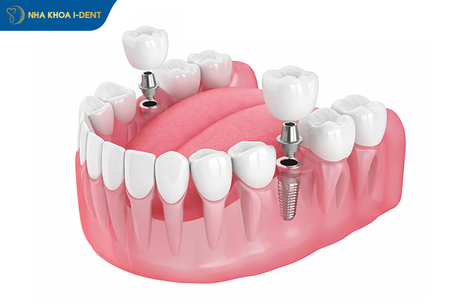 trồng răng implant 2 răng số 6 hàm dưới