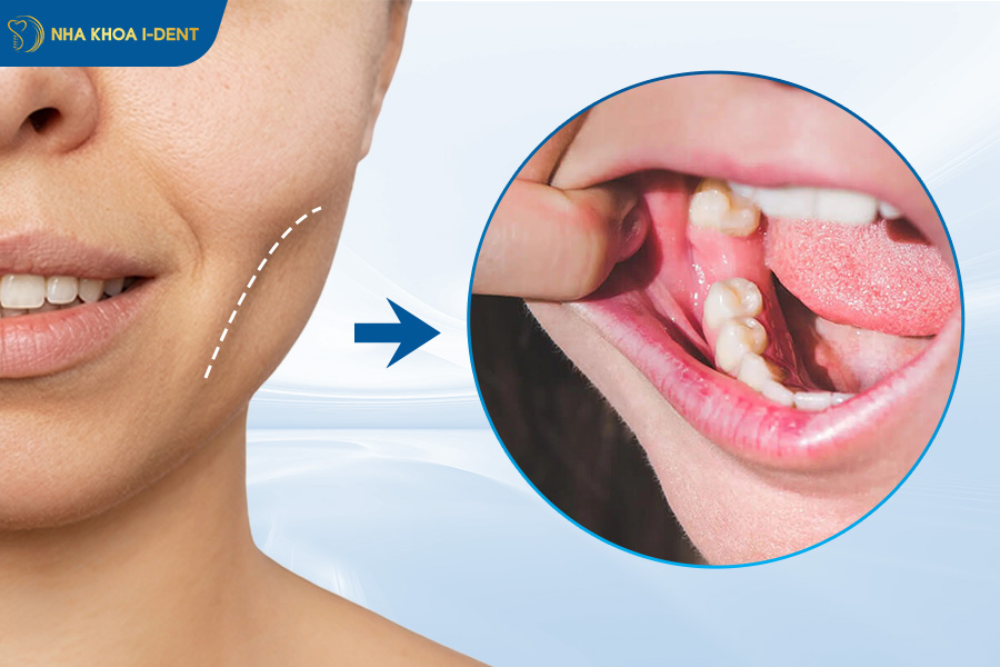 trồng răng cấm có đau không