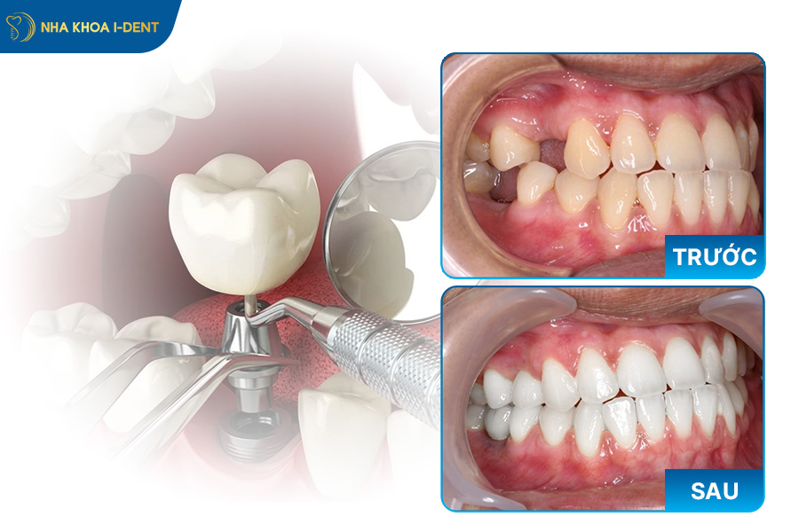 trồng răng cấm có được không