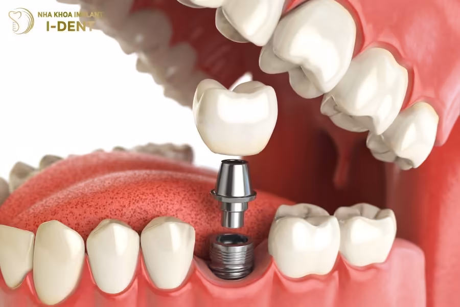 Trồng Răng Implant​