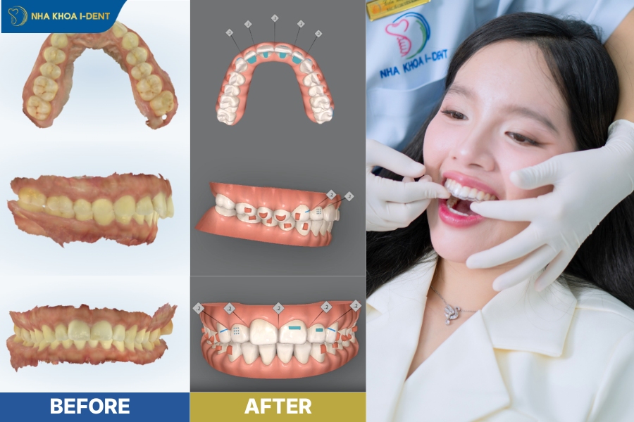 khay niềng răng trong suốt