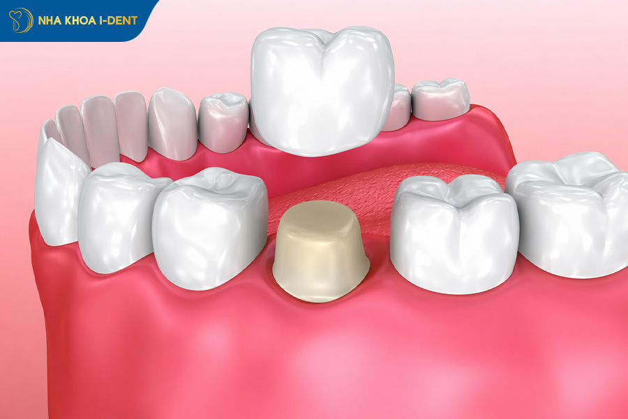 types of dental crowns