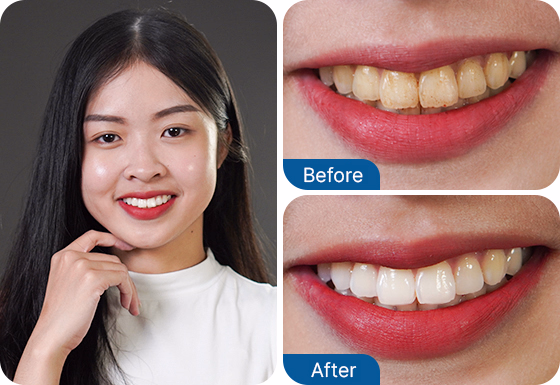 tooth veneers