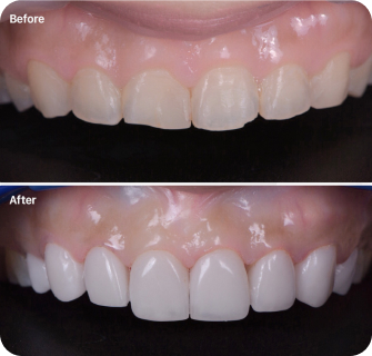 what are veneers