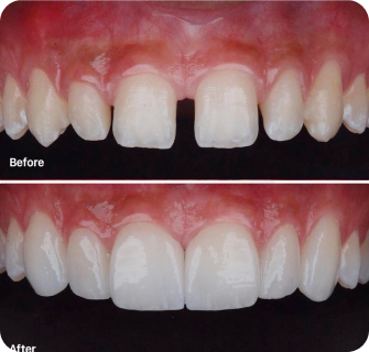 veneers teeth