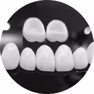 tooth veneers