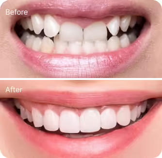 veneers