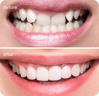 veneers