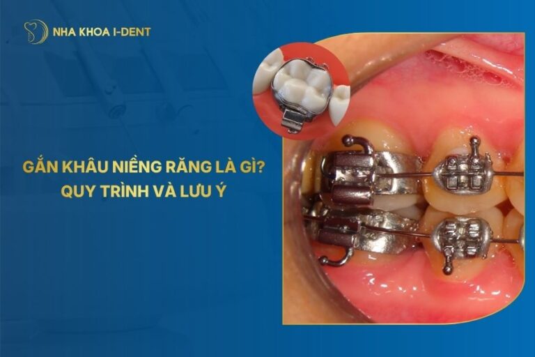 Gắn Khâu Niềng Răng Là Gì? Quy Trình Và Lưu Ý