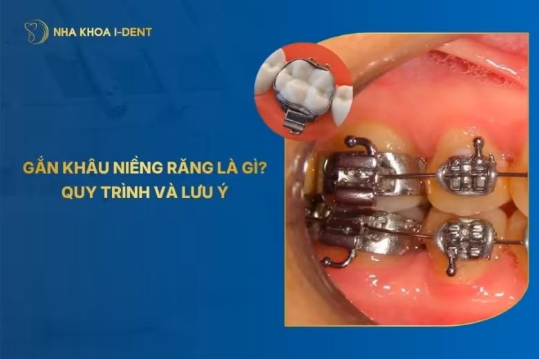 Gắn Khâu Niềng Răng Là Gì? Quy Trình Và Lưu Ý