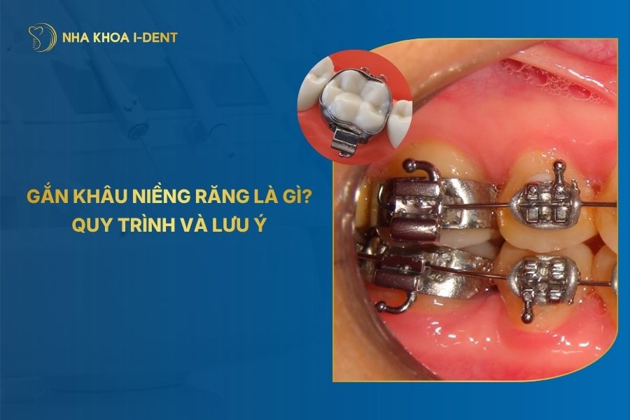 Gắn Khâu Niềng Răng Là Gì? Quy Trình Và Lưu Ý