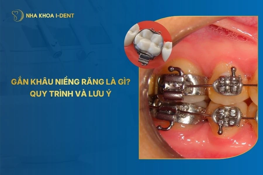 Gắn Khâu Niềng Răng Là Gì? Quy Trình Và Lưu Ý