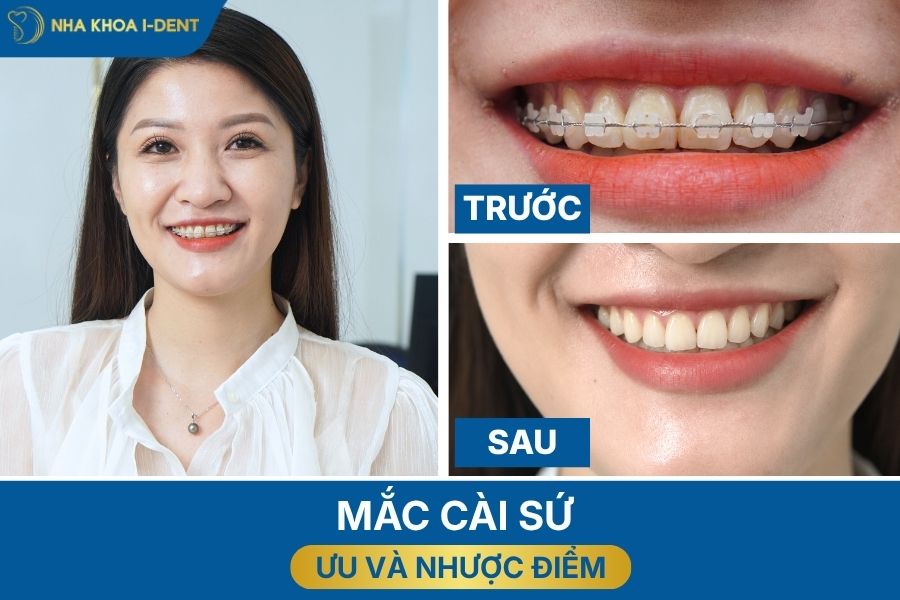 các loại mắc cài khi niềng răng